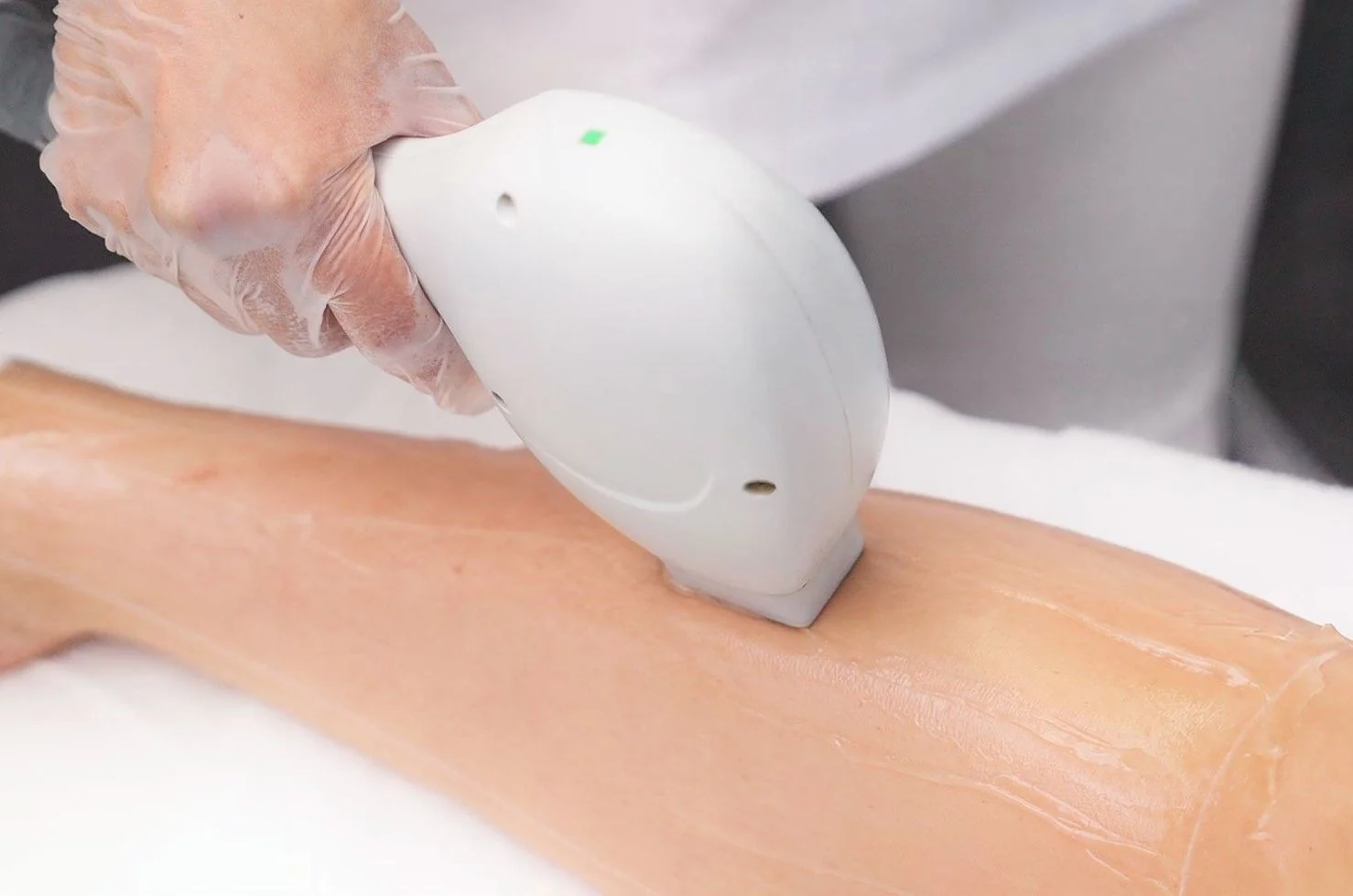 Lissera Behandlungssituation für Laser-Haarentfernung